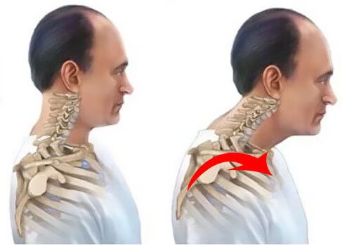 Healthy and Patient Spine
