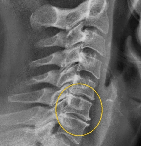 Cervical osteocondrosis