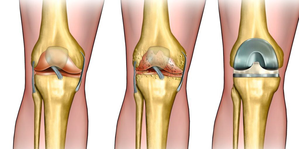 Artrosis of knee joint
