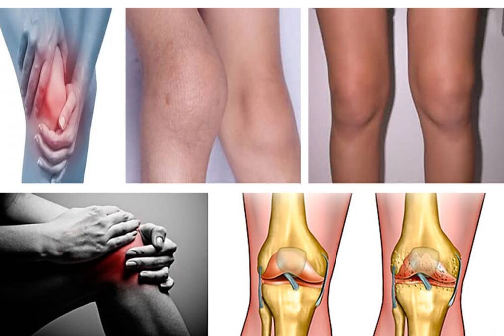 Symptoms of Artopa of the knee